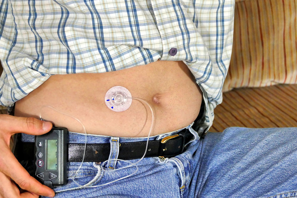 Insulin Pumps for Type 1 Diabetes &#8211; Types and Benefits