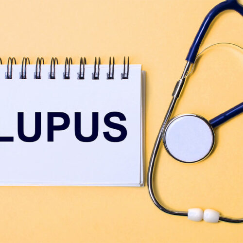 Lupus &#8211; Signs, Causes and Types