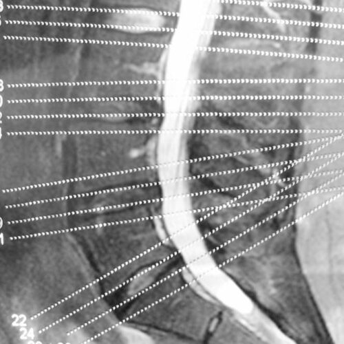 A brief overview of degenerative disc and joint disease