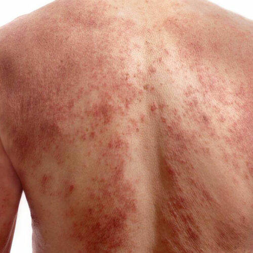 A few quick ways to identify chickenpox infection