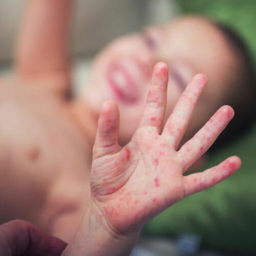 Causes and symptoms of Hand-foot-and-mouth disease