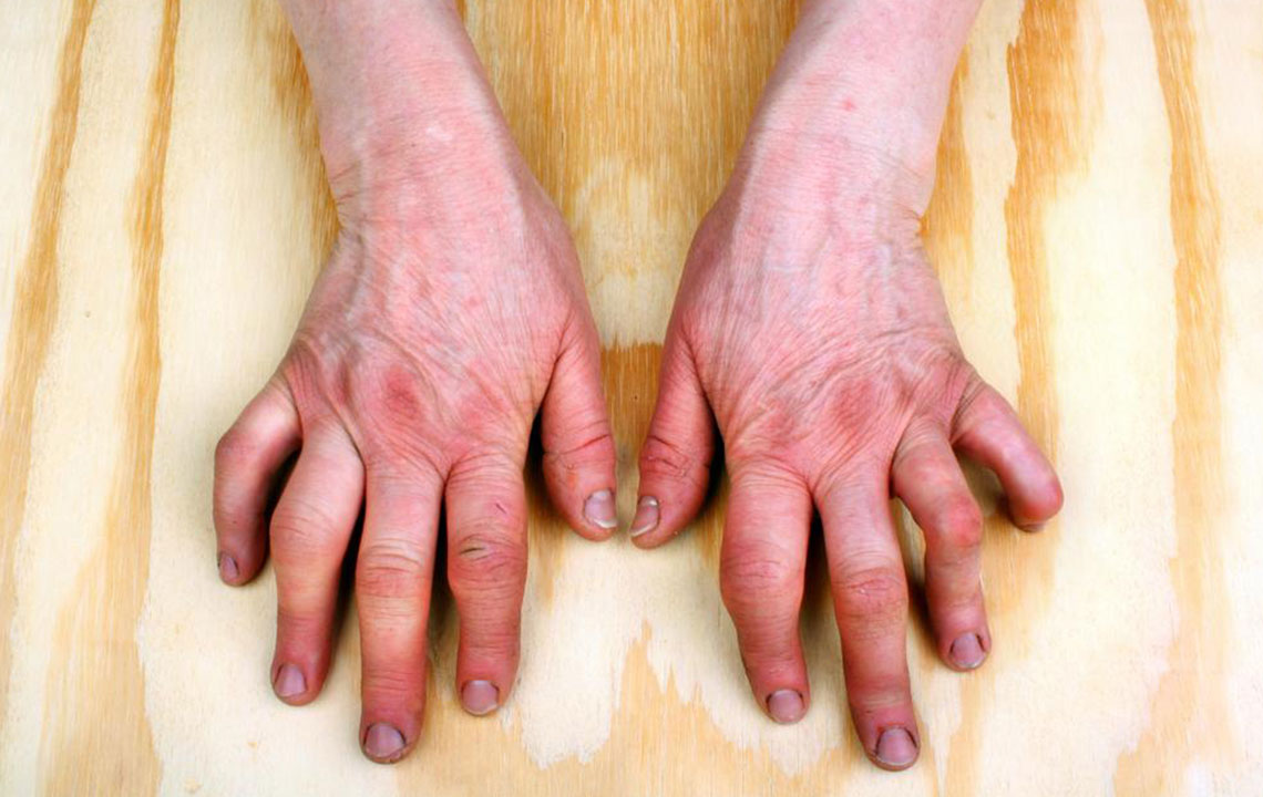 Do you have psoriatic arthritis symptoms