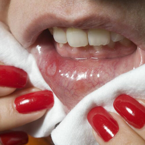 Effective ways to prevent cold sores