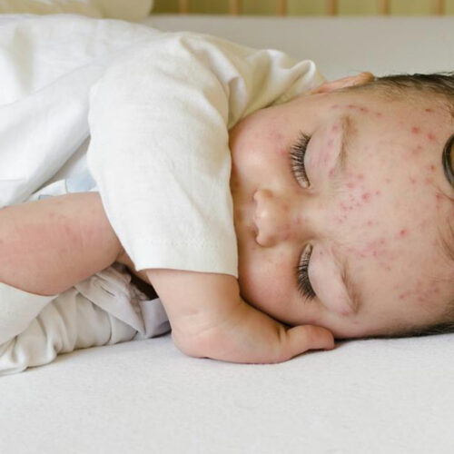 Here&#8217;s how to treat skin rashes in babies