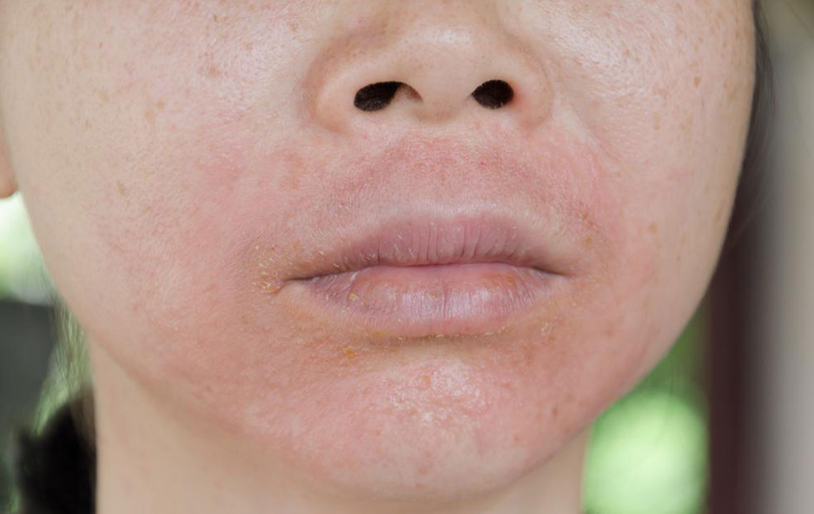 How to deal with a skin rash from an insect bite?