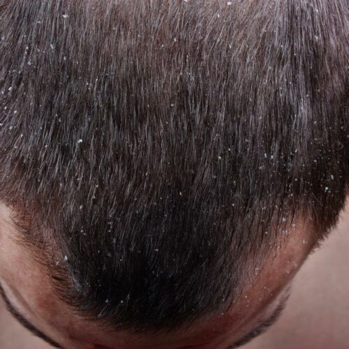 Scalp Psoriasis