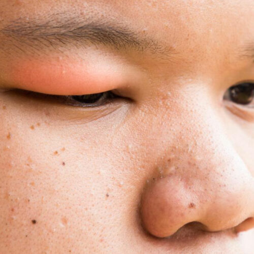 These are the causes of stye that you need to be aware of