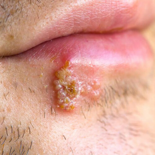 3 quick ways to deal with herpes