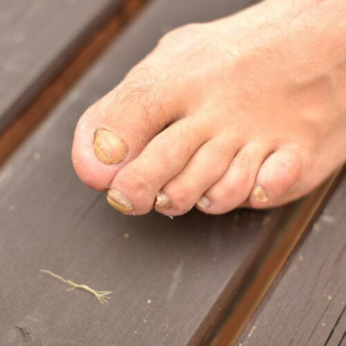 Most Beneficial Home Remedies for Toenail Fungus