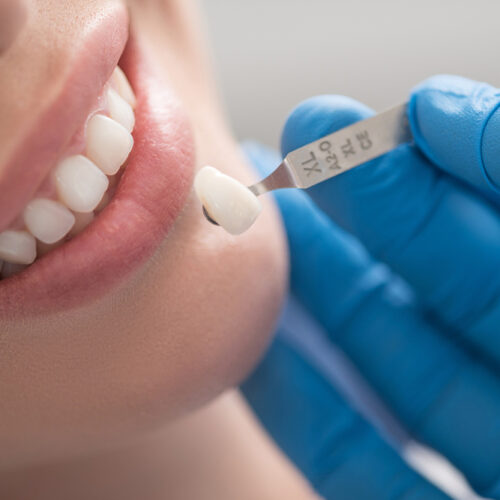 All you need to know about dental crowns and caps