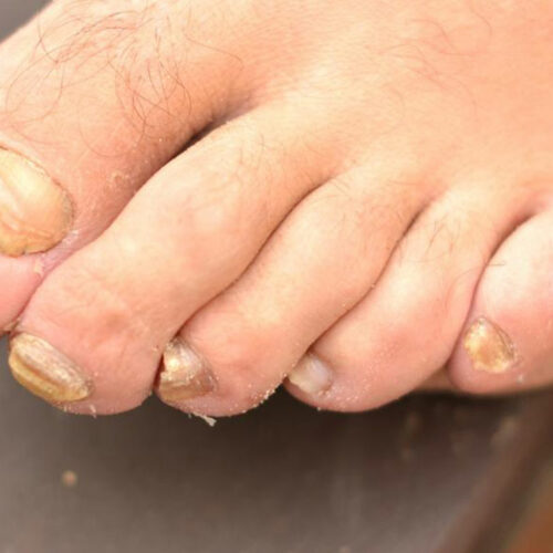 Get rid of toenail fungus with these home remedies