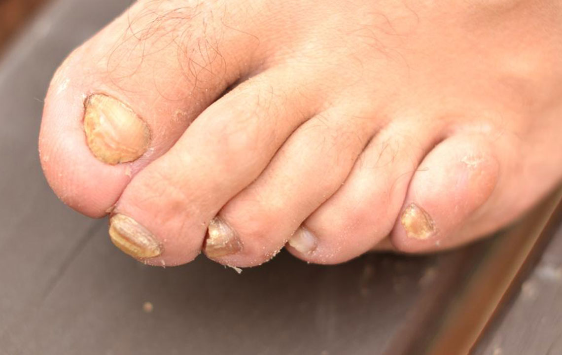 Get rid of toenail fungus with these home remedies