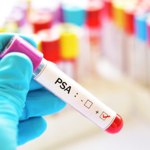 Know About Psa Levels And How To Lower Them