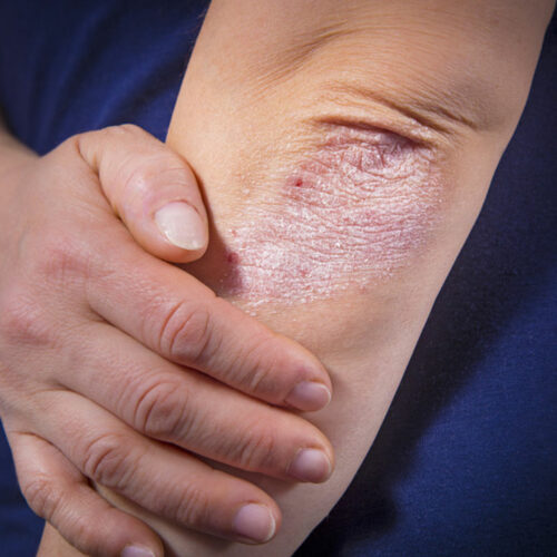 Symptoms and risk factors of psoriasis