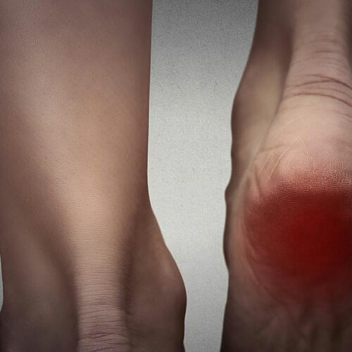 Understanding Burning Foot Pain and its Treatment Options