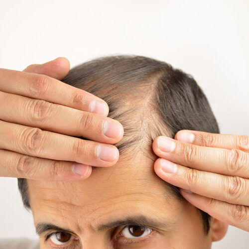 Ways to manage hair loss