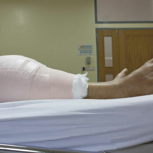 What You Need To Know About Knee Replacement Surgery