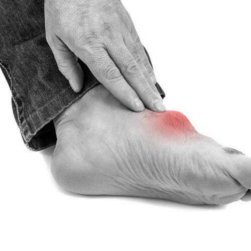 What You Need to Know about Gout