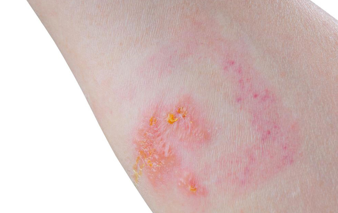 6 Home Remedies for Treating Skin Rashes