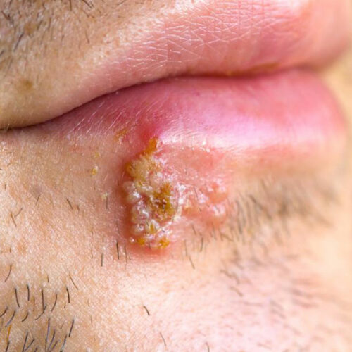 7 Tips for Treating Cold Sores