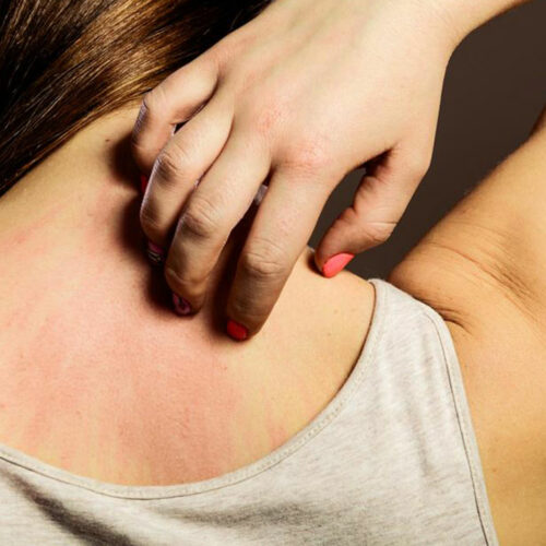 8 Simple Tips to Treat an Eczema Rash